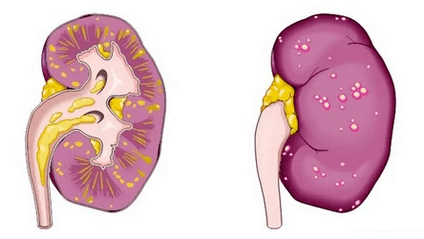 Какво е остър простатит води до