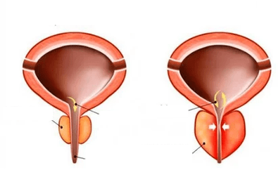 Какво е остър простатит